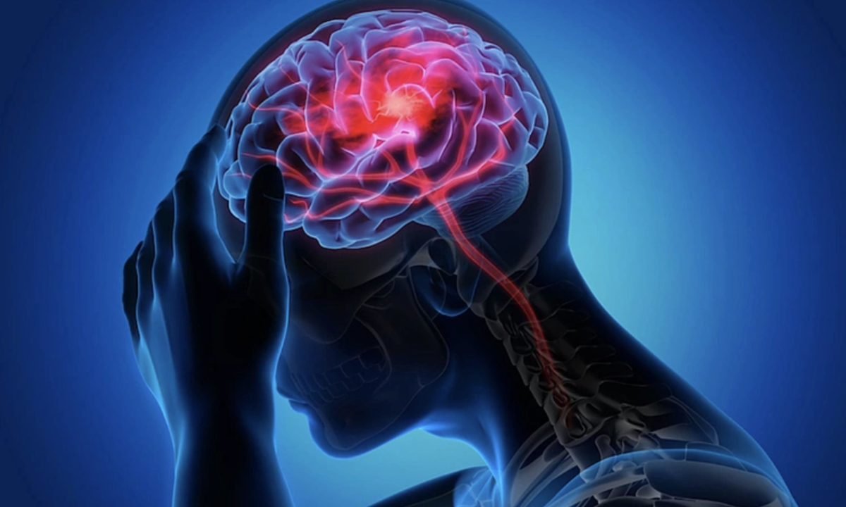 Bác sĩ Mỹ chỉ ra 7 thói quen nên tránh để ngừa đột quỵ
